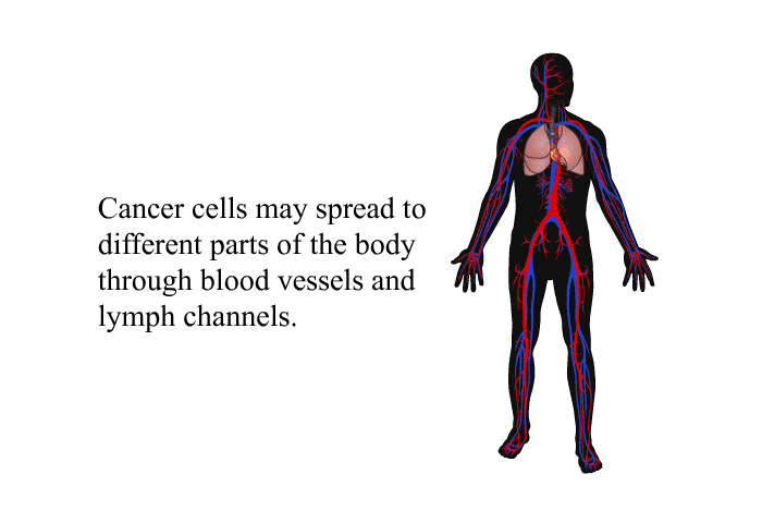 Cancer cells may spread to different parts of the body through blood vessels and lymph channels.