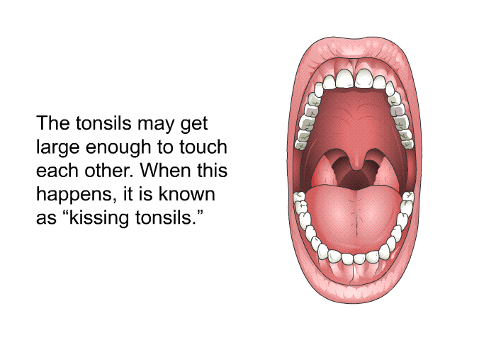 The tonsils may get large enough to touch each other. When this happens, it is known as “kissing tonsils.”