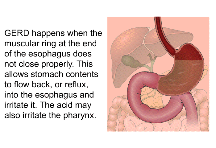 GERD happens when the muscular ring at the end of the esophagus does not close properly. This allows stomach contents to flow back, or reflux, into the esophagus and irritate it. The acid may also irritate the pharynx.