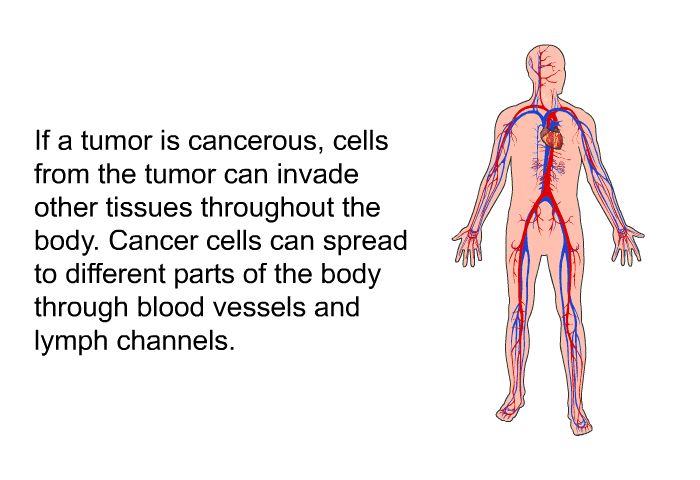 If a tumor is cancerous, cells from the tumor can invade other tissues throughout the body. Cancer cells can spread to different parts of the body through blood vessels and lymph channels.