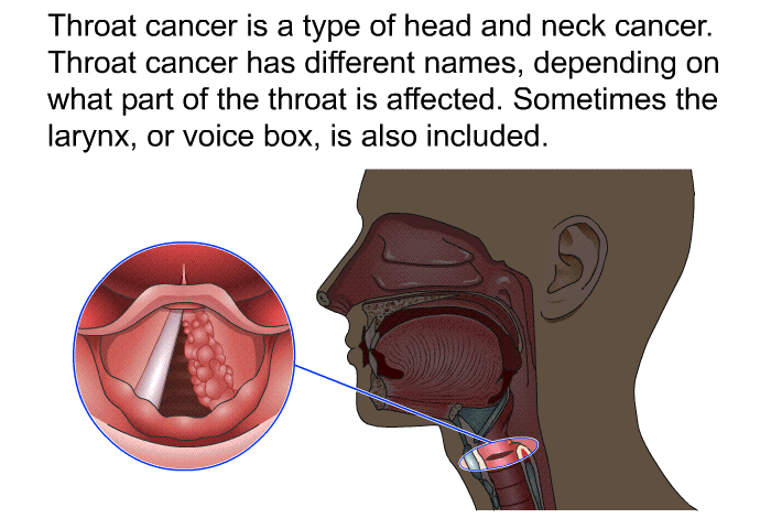 Throat cancer is a type of head and neck cancer. Throat cancer has different names, depending on what part of the throat is affected. Sometimes the larynx, or voice box, is also included.