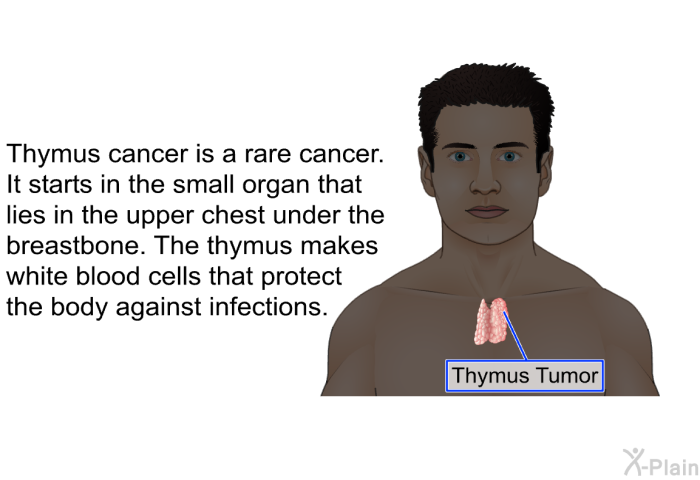 Thymus cancer is a rare cancer. It starts in the small organ that lies in the upper chest under the breastbone. The thymus makes white blood cells that protect the body against infections.