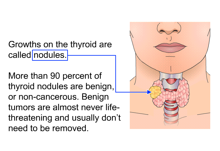 Growths on the thyroid are called nodules. More than 90 percent of thyroid nodules are benign, or non-cancerous. Benign tumors are almost never life-threatening and usually don't need to be removed.