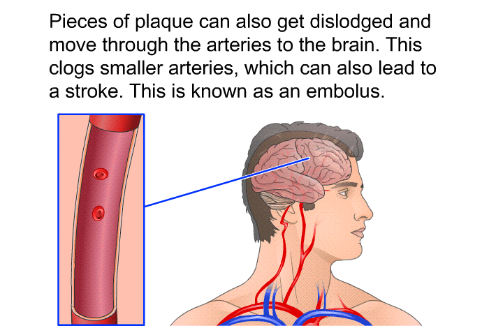 PatEdu TIA Transient Ischemic Attack