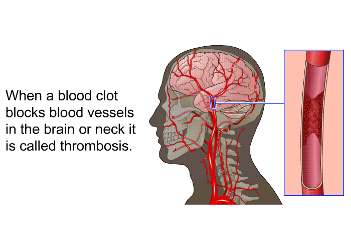 When a blood clot blocks blood vessels in the brain or neck it is called thrombosis.