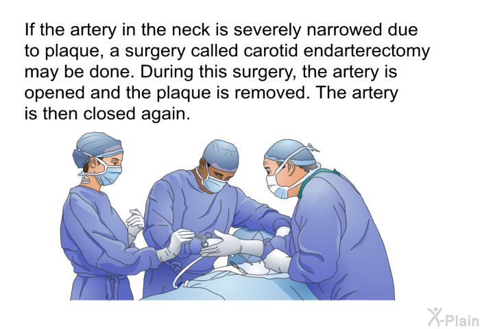 If the artery in the neck is severely narrowed due to plaque, a surgery called carotid endarterectomy may be done. During this surgery, the artery is opened and the plaque is removed. The artery is then closed again.