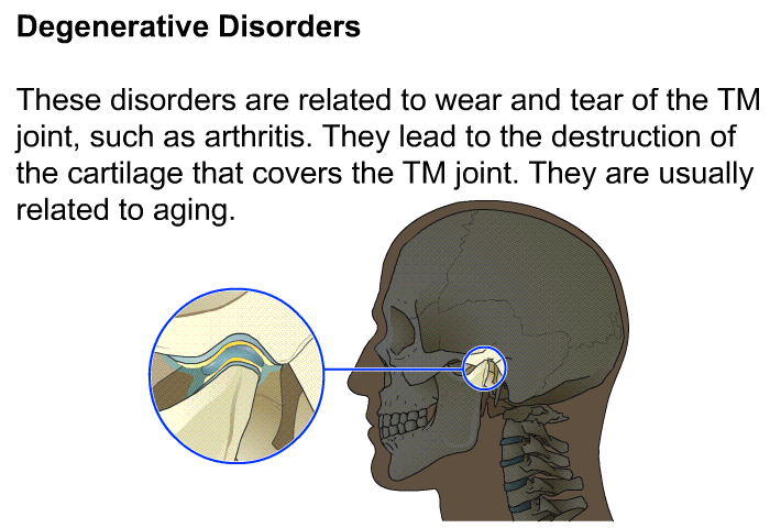 <B>Degenerative Disorders</B>
These disorders are related to wear and tear of the TM joint, such as arthritis. They lead to the destruction of the cartilage that covers the TM joint. They are usually related to aging.
