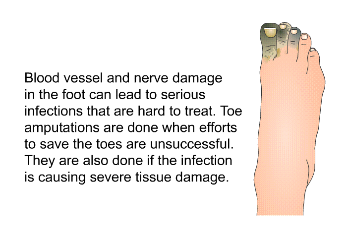 Blood vessel and nerve damage in the foot can lead to serious infections that are hard to treat. Toe amputations are done when efforts to save the toes are unsuccessful. They are also done if the infection is causing severe tissue damage.