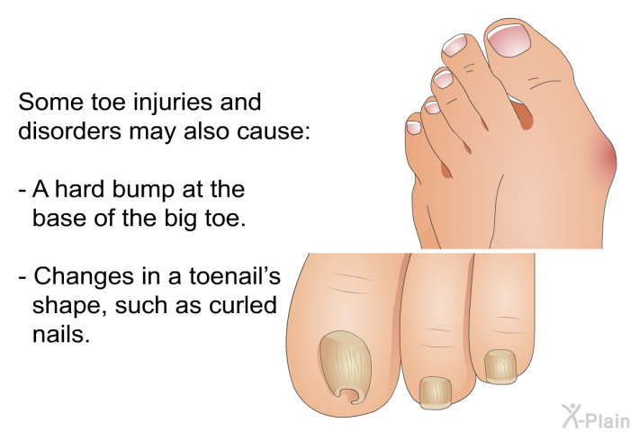 Some toe injuries and disorders may also cause:  A hard bump at the base of the big toe. Changes in a toenail's shape, such as curled nails.