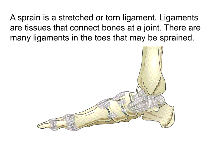 A sprain is a stretched or torn ligament. Ligaments are tissues that connect bones at a joint. There are many ligaments in the toes that may be sprained.