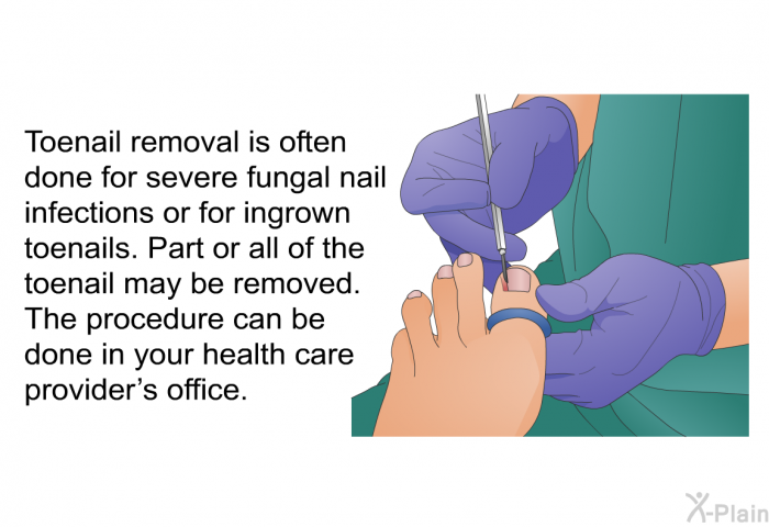 Toenail removal is often done for severe fungal nail infections or for ingrown toenails. Part or all of the toenail may be removed. The procedure can be done in your health care provider's office.