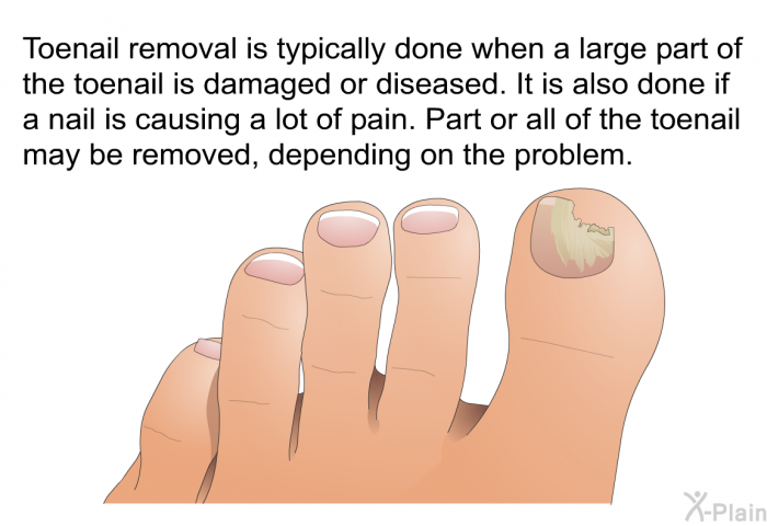 Toenail removal is typically done when a large part of the toenail is damaged or diseased. It is also done if a nail is causing a lot of pain. Part or all of the toenail may be removed, depending on the problem.