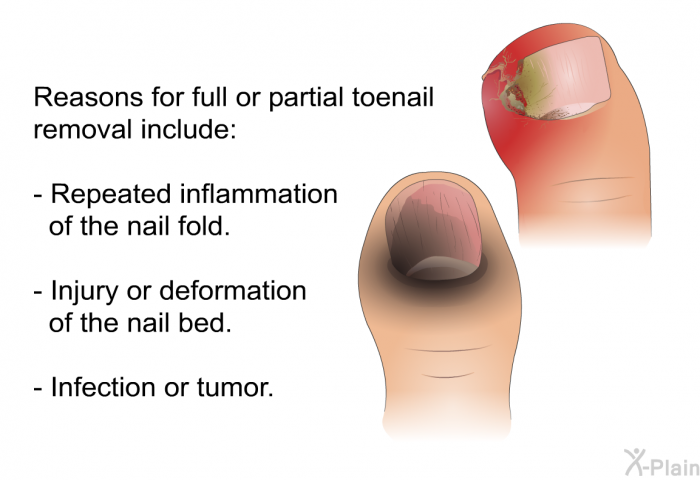 Reasons for full or partial toenail removal include:  Repeated inflammation of the nail fold. Injury or deformation of the nail bed. Infection or tumor.