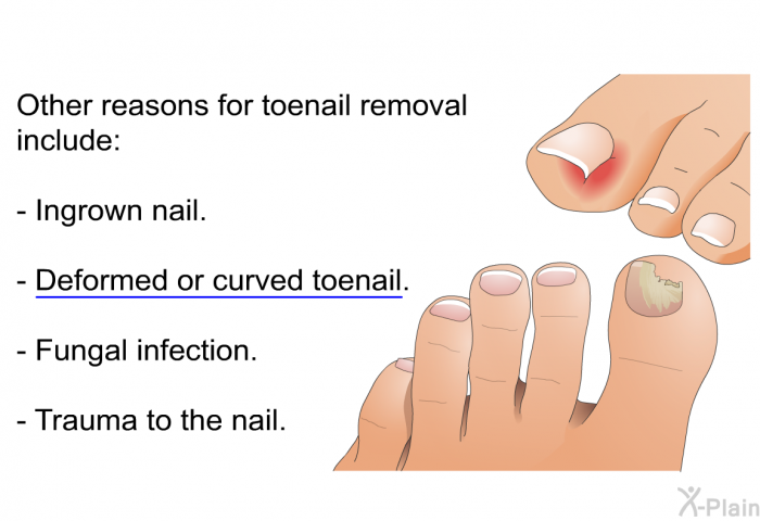 Other reasons for toenail removal include:  Ingrown nail. Deformed or curved toenail. Fungal infection. Trauma to the nail.