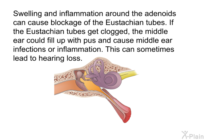 Swelling and inflammation around the adenoids can cause blockage of the Eustachian tubes. If the Eustachian tubes get clogged, the middle ear could fill up with pus and cause middle ear infections or inflammation. This can sometimes lead to hearing loss.