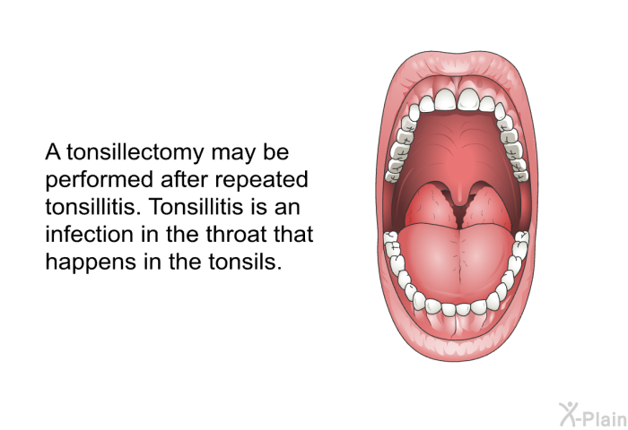 A tonsillectomy may be performed after repeated tonsillitis. Tonsillitis is an infection in the throat that happens in the tonsils.
