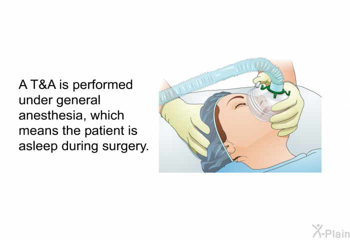 A T&A is performed under general anesthesia, which means the patient is asleep during surgery.