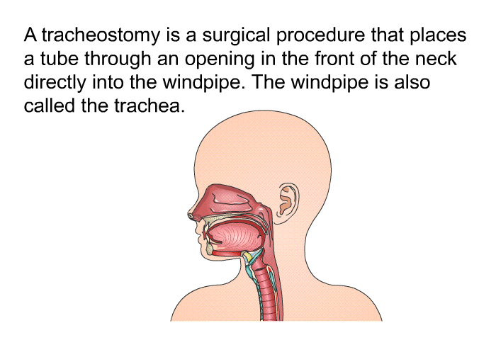 A tracheostomy is a surgical procedure that places a tube through an opening in the front of the neck directly into the windpipe. The windpipe is also called the trachea.