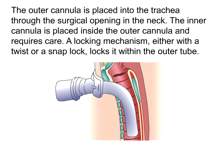The outer cannula is placed into the trachea through the surgical opening in the neck. The inner cannula is placed inside the outer cannula and requires care. A locking mechanism, either with a twist or a snap lock, locks it within the outer tube.