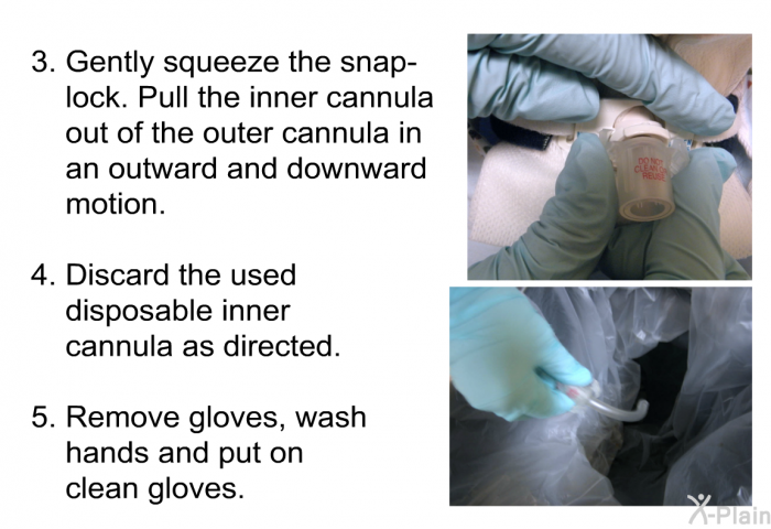 Gently squeeze the snap-lock. Pull the inner cannula out of the outer cannula in an outward and downward motion. Discard the used disposable inner cannula as directed. Remove gloves, wash hands and put on clean gloves.