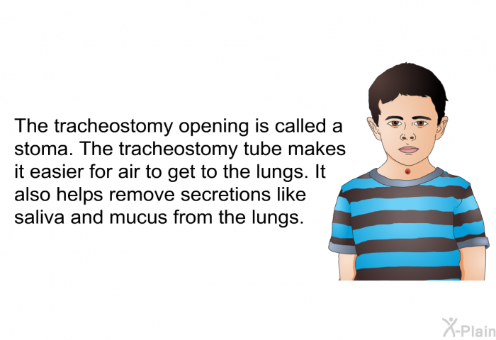 The tracheostomy opening is called a stoma. The tracheostomy tube makes it easier for air to get to the lungs. It also helps remove secretions like saliva and mucus from the lungs.