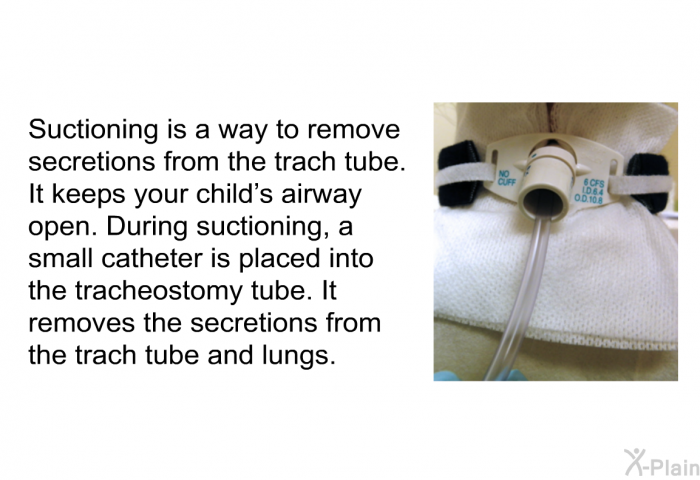 Suctioning is a way to remove secretions from the trach tube. It keeps your child's airway open. During suctioning, a small catheter is placed into the tracheostomy tube. It removes the secretions from the trach tube and lungs.