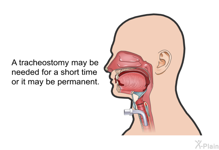 A tracheostomy may be needed for a short time or it may be permanent.