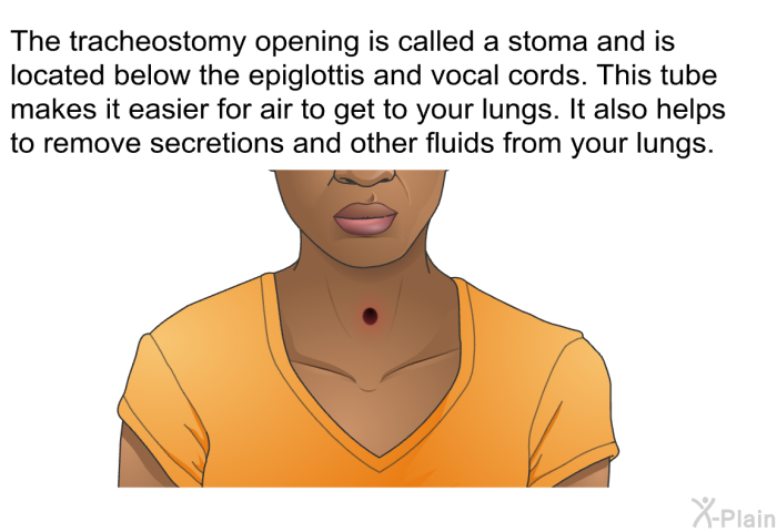 The tracheostomy opening is called a stoma and is located below the epiglottis and vocal cords. This tube makes it easier for air to get to your lungs. It also helps to remove secretions and other fluids from your lungs.
