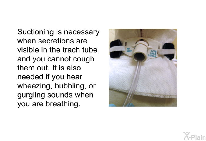 Suctioning is necessary when secretions are visible in the trach tube and you cannot cough them out. It is also needed if you hear wheezing, bubbling, or gurgling sounds when you are breathing.