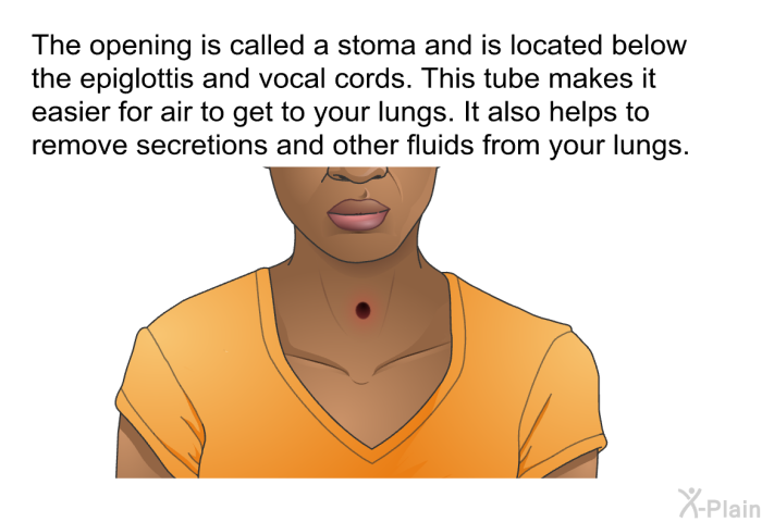 The opening is called a stoma and is located below the epiglottis and vocal cords. This tube makes it easier for air to get to your lungs. It also helps to remove secretions and other fluids from your lungs.
