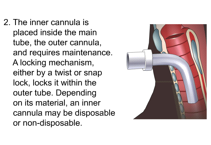 The inner cannula is placed inside the main tube, the outer cannula and requires maintenance. A locking mechanism, either by a twist or snap lock, locks it within the outer tube. Depending on its material, an inner cannula may be disposable or non-disposable.