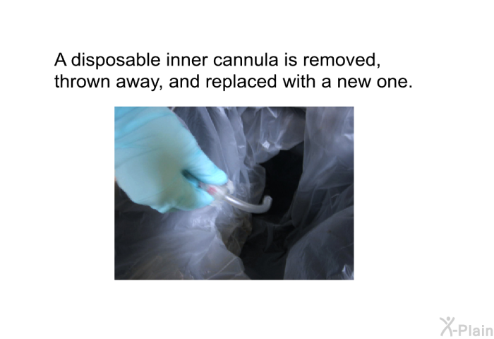 A disposable inner cannula is removed, thrown away and replaced with a new one.