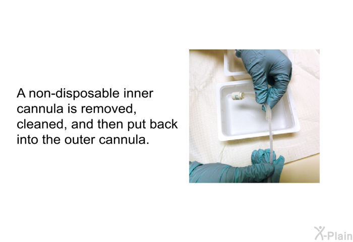 A non-disposable inner cannula is removed, cleaned and then put back into the outer cannula.