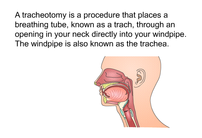 A tracheotomy is a procedure that places a breathing tube, known as a trach, through an opening in your neck directly into your windpipe. The windpipe is also known as the trachea.