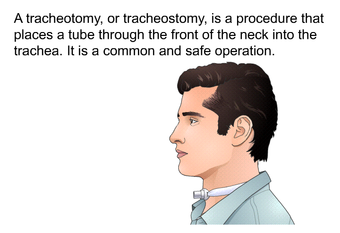 A tracheotomy, or tracheostomy, is a procedure that places a tube through the front of the neck into the trachea. It is a common and safe operation.