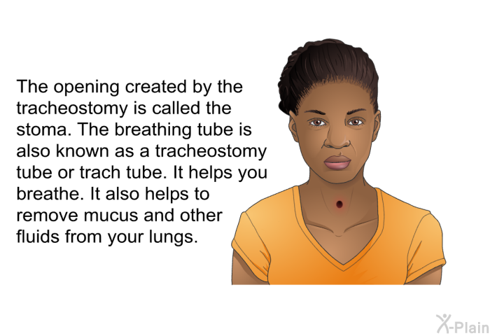 The opening created by the tracheostomy is called the stoma. The breathing tube is also known as a tracheostomy tube or trach tube. It helps you breathe. It also helps to remove mucus and other fluids from your lungs.