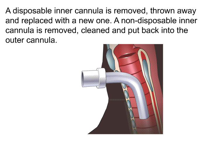 A disposable inner cannula is removed, thrown away and replaced with a new one. A non-disposable inner cannula is removed, cleaned and put back into the outer cannula.