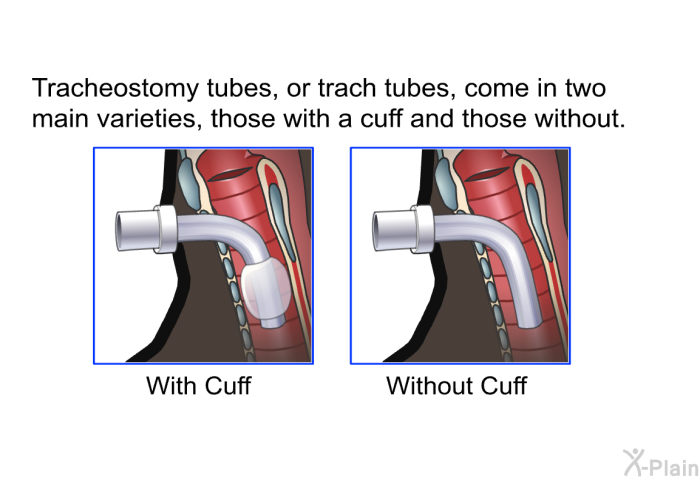 Tracheostomy tubes, or trach tubes, come in two main varieties, those with a cuff and those without.