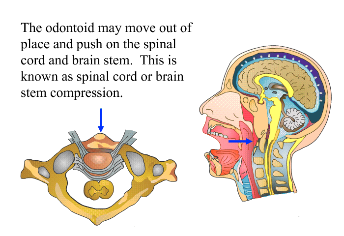 The odontoid may move out of place and push on the spinal cord and brain stem. This is known as spinal cord or brain stem compression.