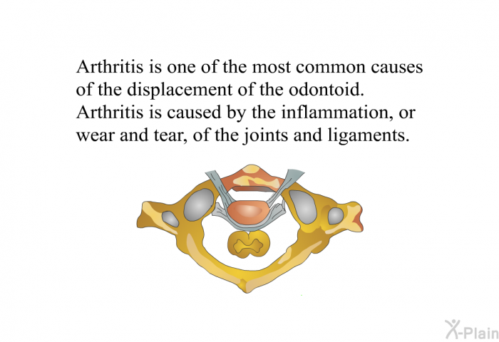Arthritis is one of the most common causes of the displacement of the odontoid. Arthritis is caused by the inflammation, or wear and tear, of the joints and ligaments.