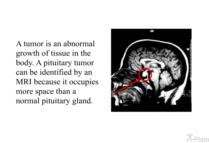 A tumor is an abnormal growth of tissue in the body. A pituitary tumor can be identified by an MRI because it occupies more space than a normal pituitary gland.