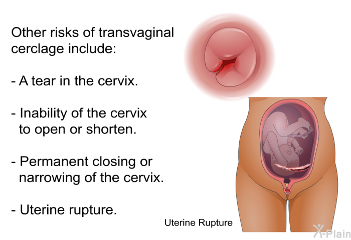 Other risks of transvaginal cerclage include:  A tear in the cervix. Inability of the cervix to open or shorten. Permanent closing or narrowing of the cervix. Uterine rupture.