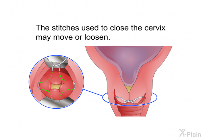 The stitches used to close the cervix may move or loosen.