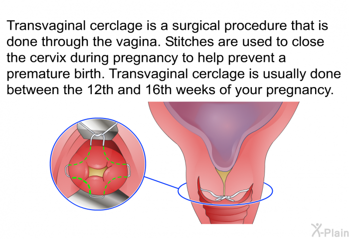Transvaginal cerclage is a surgical procedure that is done through the vagina. Stitches are used to close the cervix during pregnancy to help prevent a premature birth. Transvaginal cerclage is usually done between the 12th and 16th weeks of your pregnancy.