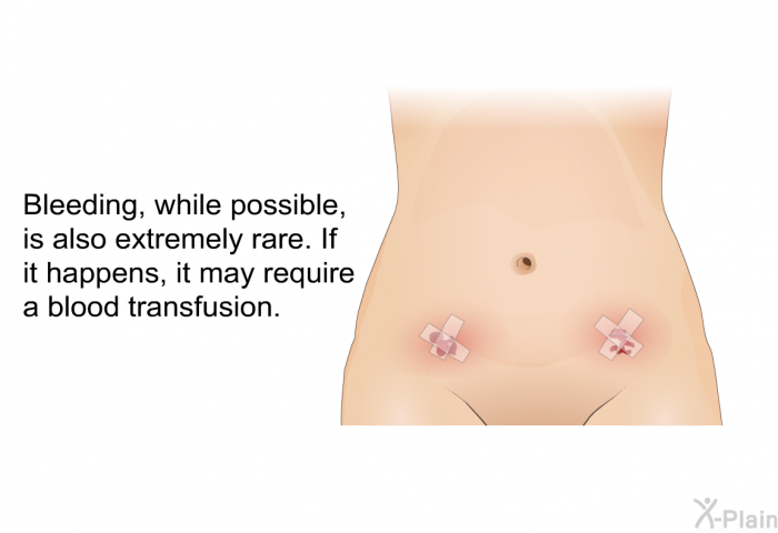 Bleeding, while possible, is also extremely rare. If it happens, it may require a blood transfusion.