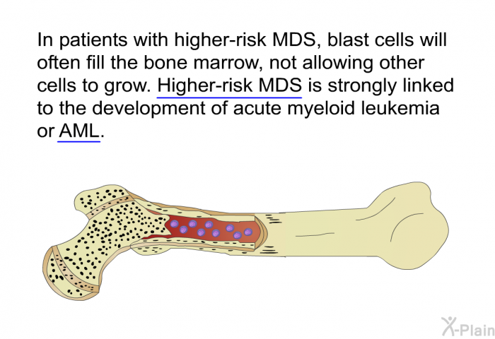 In patients with higher-risk MDS, blast cells will often fill the bone marrow, not allowing other cells to grow. Higher-risk MDS is strongly linked to the development of acute myeloid leukemia or AML.