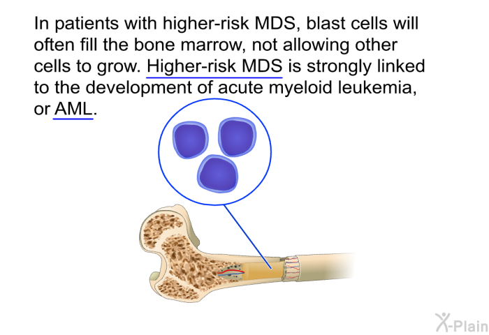 In patients with higher-risk MDS, blast cells will often fill the bone marrow, not allowing other cells to grow. Higher-risk MDS is strongly linked to the development of acute myeloid leukemia, or AML.
