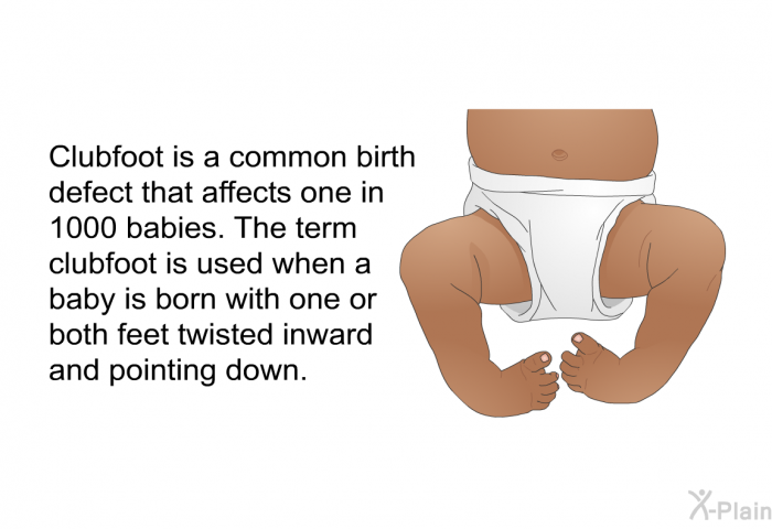 Clubfoot is a common birth defect that affects one in 1000 babies. The term clubfoot is used when a baby is born with one or both feet twisted inward and pointing down.