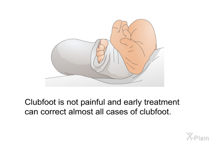 Clubfoot is not painful and early treatment can correct almost all cases of clubfoot.