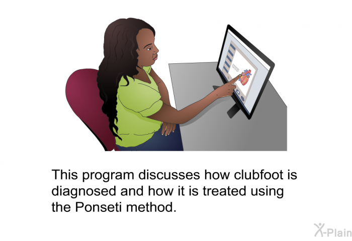 This health information discusses how clubfoot is diagnosed and how it is treated using the Ponseti method.